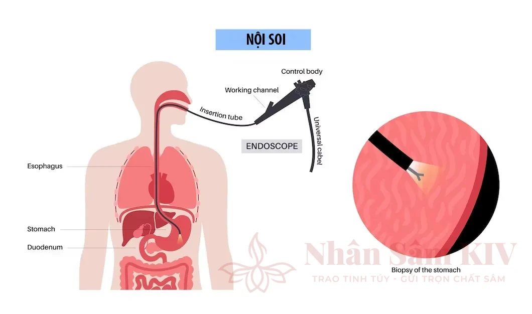 Các phương pháp nội soi dạ dày