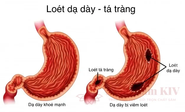 Các triệu chứng thường gặp của bệnh viêm loét dạ dày - tá tràng