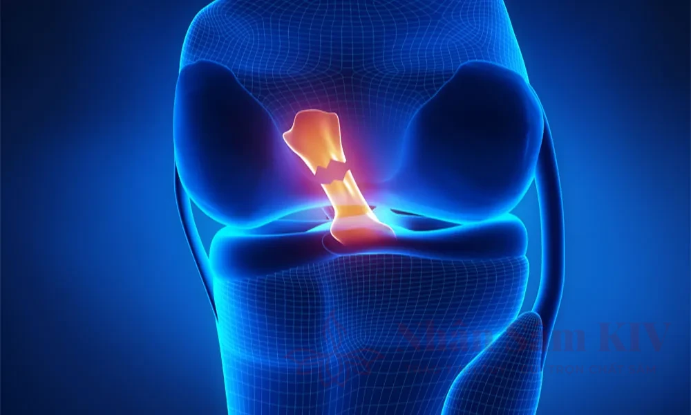 Đứt dây chằng chéo trước (ACL) & rách sụn chêm