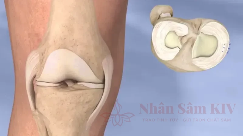 Làm thế nào để bảo vệ sụn chêm