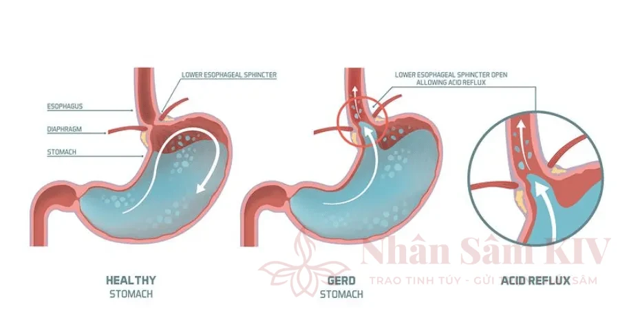 Nhận biết sớm các dấu hiệu của trào ngược dạ dày - thực quản (GERD)