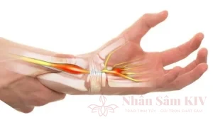 Tê bì ngón tay do hội chứng ống cổ tay
