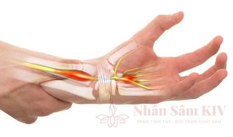 Tê bì ngón tay do hội chứng ống cổ tay