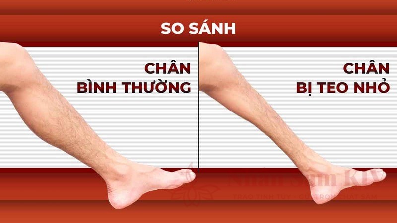 Teo cơ do ít vận động