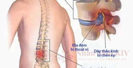 Thoát vị đĩa đệm chèn ép rễ thần kinh