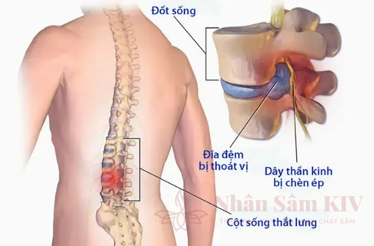 Thoát vị đĩa đệm chèn ép rễ thần kinh