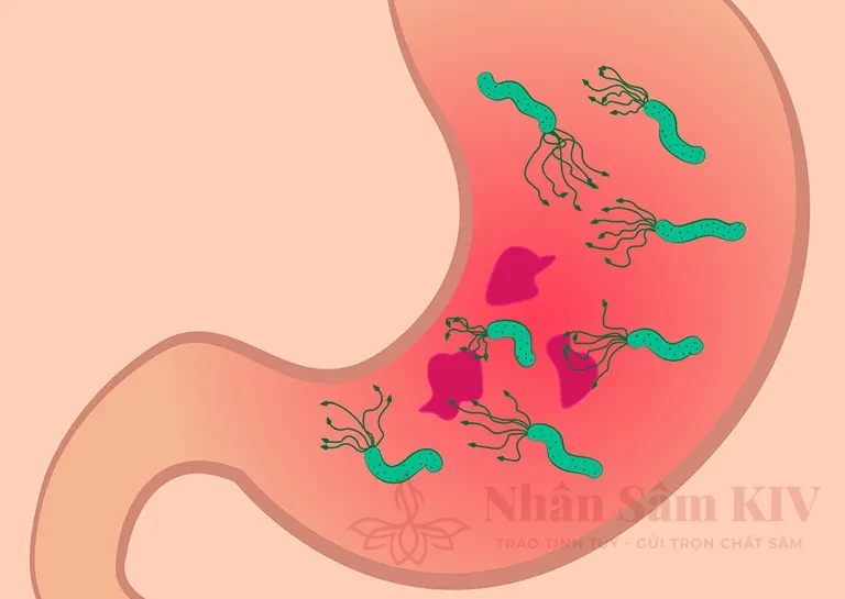 Vai trò của vi khuẩn Helicobacter pylori (HP) trong bệnh lý viêm loét dạ dày