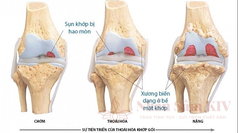 Bài tập cho người bị thoái hóa khớp