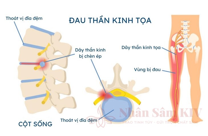 Cách điều trị đau thần kinh tọa