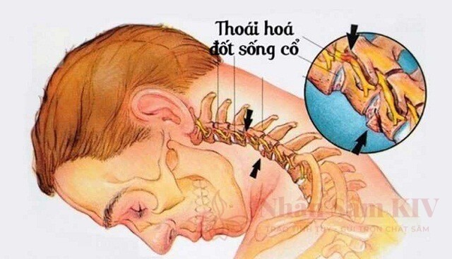 Dấu hiệu thoái hóa cột sống cổ dẫn đến thiếu máu não