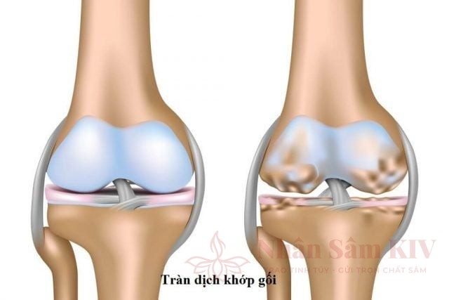 Mức độ nguy hiểm của tràn dịch khớp gối