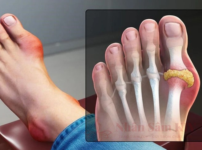 Những điều cần biết về bệnh Gout