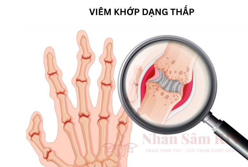 Triệu chứng của viêm khớp dạng thấp