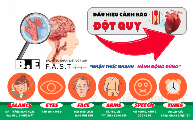 Cảnh báo dấu hiệu đột quỵ