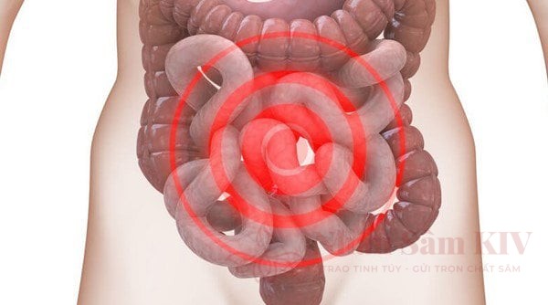Tìm hiểu nguyên nhân hội chứng ruột kích thích