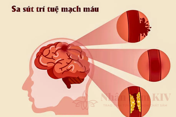 Sa sút trí tuệ do mạch máu