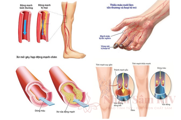 Suy giảm tuần ho&agrave;n ngoại vi