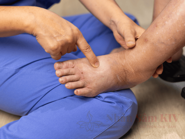 Gây phù nề và ứ nước toàn thân